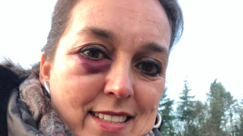 Operazangeres Mylou Mazali uit Baarn blauw oog geslagen na vuurwerkruzie 